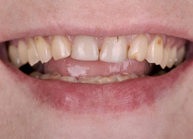 A patient who does not live in Ukraine came to the dental clinic wishing to have a beautiful smile. The patient did not like the shape, color, and size of her teeth, which made her feel insecure while having a conversation.
