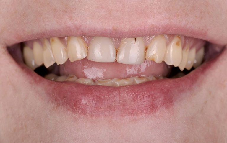 Full mouth rehabilitation using all-ceramic crowns for a patient with pathological abrasion and complicated tooth decay