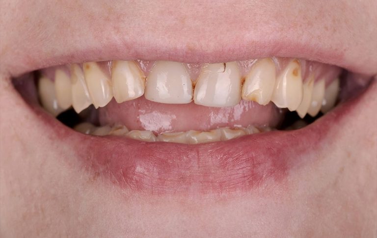 A patient who does not live in Ukraine came to the dental clinic wishing to have a beautiful smile. The patient did not like the shape, color, and size of her teeth, which made her feel insecure while having a conversation.