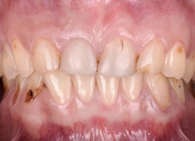 Зубы имели патологическую стираемость. Наблюдалась выраженная ассиметрия лица. Перед стоматологами стояла задача в короткие сроки сделать полную реабилитацию зубов.