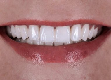 After the full-mouth debridement, temporary crowns for both upper and lower jaws were made. The patient finally approved the shape and color of the teeth, the dentists took the impressions and sent them to the dental laboratory.