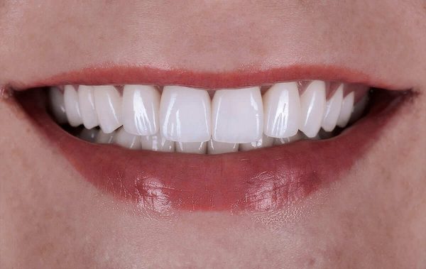 Реабилитация полости рта цельнокерамическими коронками у пациентки с патологической стираемостью и осложненным кариесом