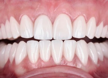 Через 8 дней были изготовлены цельнокерамические коронки отдельно на каждый зуб, которые после примерки были фиксированы в полости рта.