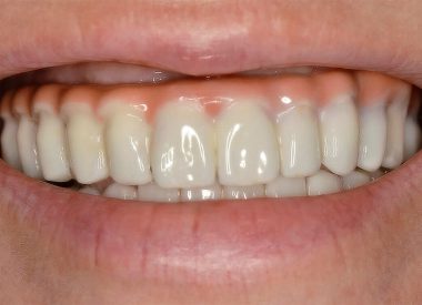 The patient contacted us with following complaints. After installing implants on both jaws («all-on-4») half of a year ago, zirconium crowns with screw fixing were made for her in Costa Rica. On the photo we see that incisal line is located outside the horizontal plane and during the broad smile bared artificial gums are shown...