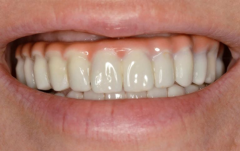 Crowns replacement on both jaws with zirconium crowns on implants