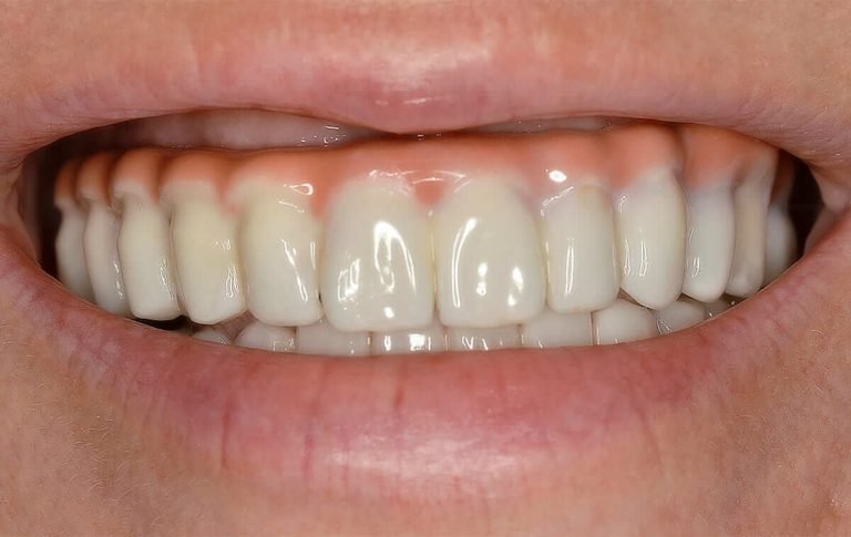 The patient contacted us with following complaints. After installing implants on both jaws («all-on-4») half of a year ago, zirconium crowns with screw fixing were made for her in Costa Rica. On the photo we see that incisal line is located outside the horizontal plane and during the broad smile bared artificial gums are shown...