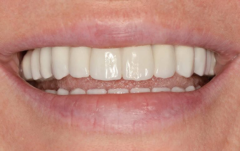 Crowns replacement on both jaws with zirconium crowns on implants