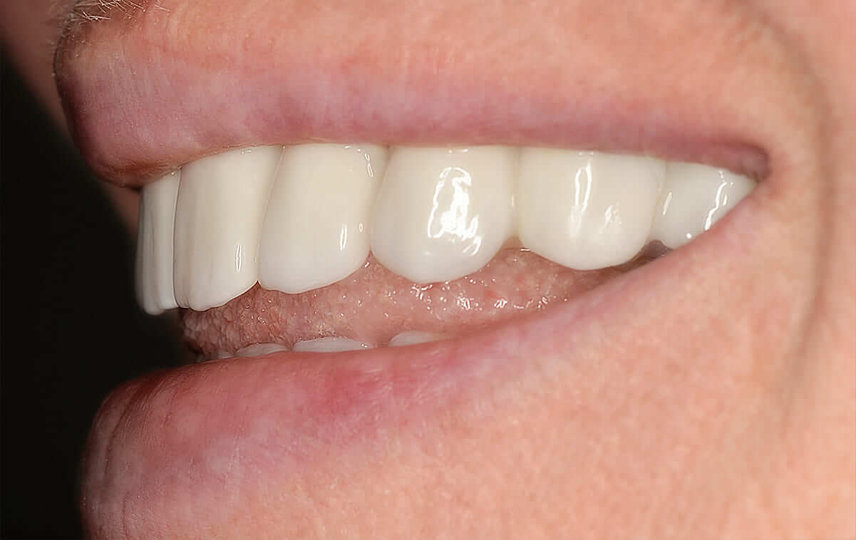 New zirconium crowns were made which satisfied requests of the patient completely.