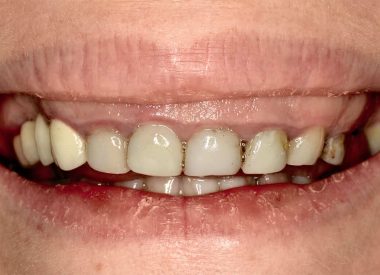 The patient contacted the clinic with a view to correct the "gum" smile and improve the appearance of her teeth. A plastic surgery was performed in the gum area, as a result of which the shape of teeth became longer and the gum visibility when smiling was reduced.