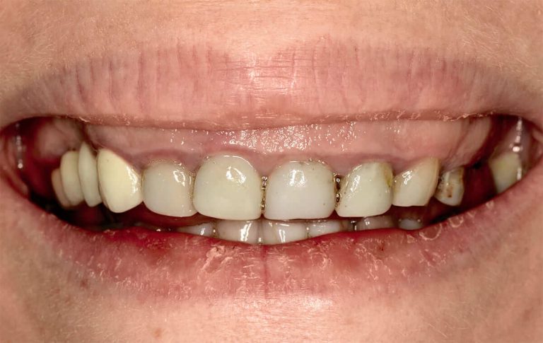 Plastic surgery of the gum area and a subsequent prosthetic treatment and placement of all-ceramic crowns in the case of a patient with a high-pitched smile