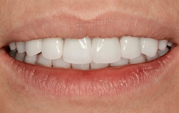 Plastic surgery of the gum area and a subsequent prosthetic treatment and placement of all-ceramic crowns in the case of a patient with a high-pitched smile