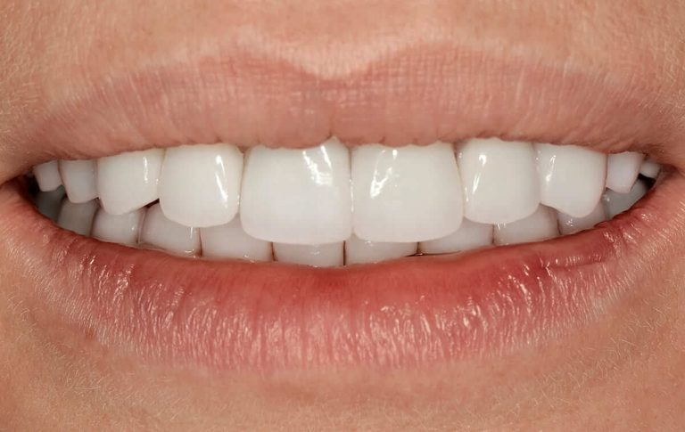 Plastic surgery of the gum area and a subsequent prosthetic treatment and placement of all-ceramic crowns in the case of a patient with a high-pitched smile