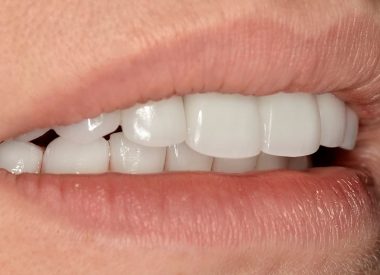 Some time later, all-ceramic crowns were placed in the area to complete the treatment.
