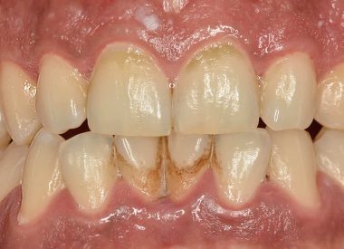 The patient said he had last visited a dental hygienist three years previously. A substantial plaque build-up was visible on the teeth and soft tissue. A further examination revealed the first stages of periodontal disease, caused by a lack of dental care and non-attendance of hygienic appointments.
