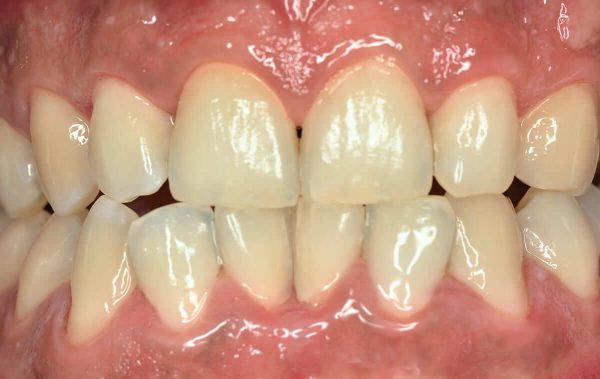 The initial stage of periodontal disease