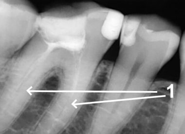 Пациентка обратилась с жалобой на дефект старой реставрации коронки 46 зуба на нижней челюсти. 1 – на прицельном рентгенологическом снимке определяется не герметичное заполнение корневых каналов пломбировочным материалом. В один визит проведено повторное эндодонтическое лечение, полное извлечение остатков пломбировочной массы, дезинфекция в режиме 3Д формата под увеличением, герметичное заполнение корневых каналов.