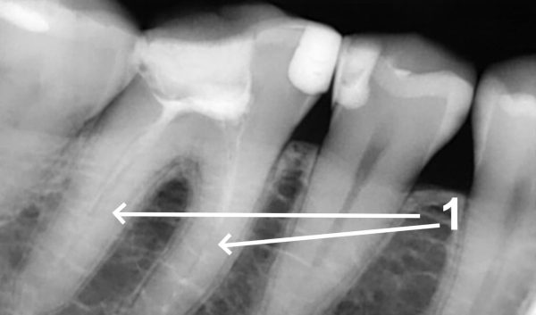 Tooth Preparation for Dentures, Scheduled Endodontic Therapy