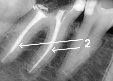 2 – check-up X-ray of root canal filling. Sealed root canal filling – a guarantee of a positive prognosis.