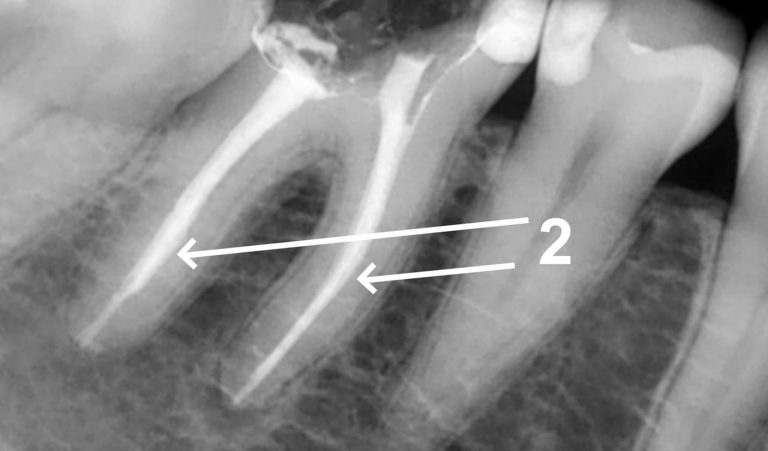 Tooth Preparation for Dentures, Scheduled Endodontic Therapy