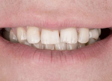Пацієнт звернувся в клініку з проханням отримати красиві рівні зуби, природну посмішку і всі зуби повинні бути розташовані симетрично в зубному ряду.