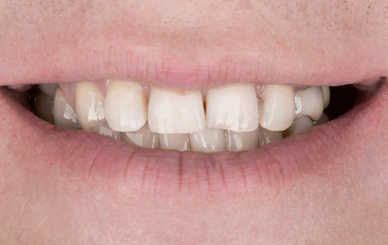 The patient contacted the clinic to get beautiful, even teeth, a natural smile with all teeth located symmetrically.
