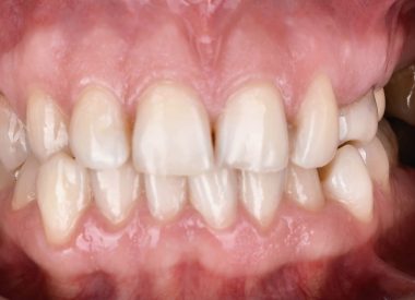He refused orthodontic treatment with braces. The patient had tooth abrasion in posterior regions; the upper left canine was missing, and the upper right canine had a mesial slope.