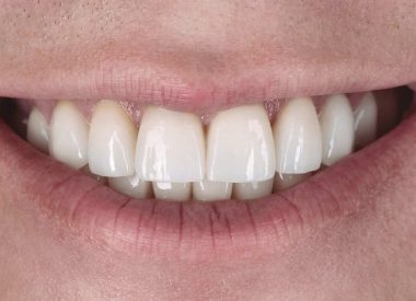 After coordinating the shape and color of the future ceramic restorations, the teeth with minimum preparation were covered with temporary crowns and veneers.
