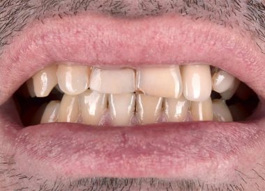 Many years ago, the patient got his teeth chipped due to a boxing injury. Later, endodontic treatment of 11, 22, 23 teeth was performed. The 22 tooth was replaced with a porcelain-fused-to-metal crown.