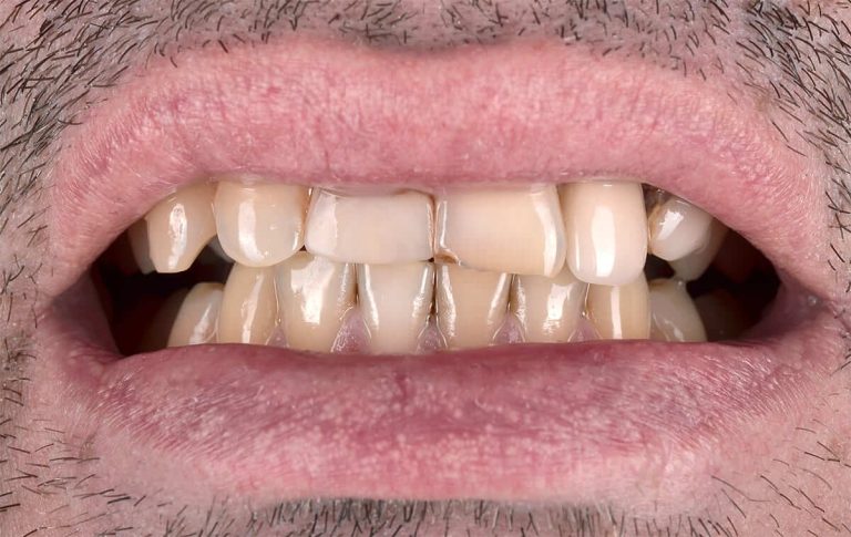 Багато років назад Пацієнт отримав травматичні сколи зубів під час тренування з боксу. Після цього було проведено ендодонтичне лікування 11, 22, 23 зубів. Зуб 22 запротезований металокерамічною коронкою.