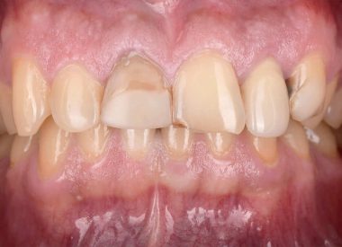 На момент звернення Пацієнта не влаштовував естетичний результат лікування верхніх фронтальних зубів.