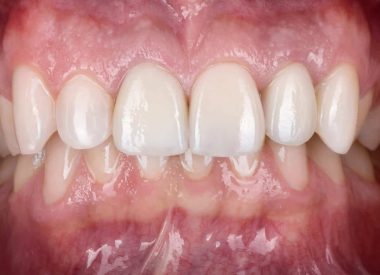 The main difficulty was that the 11, 21, 22, and 23 teeth differed from each other in color. Our task was to make ceramic restorations so that they did not differ in color and shape after cementation.