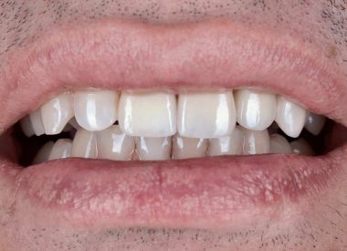 Также Пациент попросил вернуть ему форму зубов, которая была до травмы.