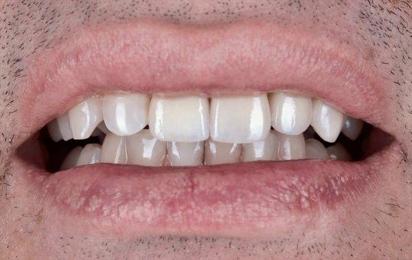Prosthetics of front teeth with zirconia crowns after sport trauma
