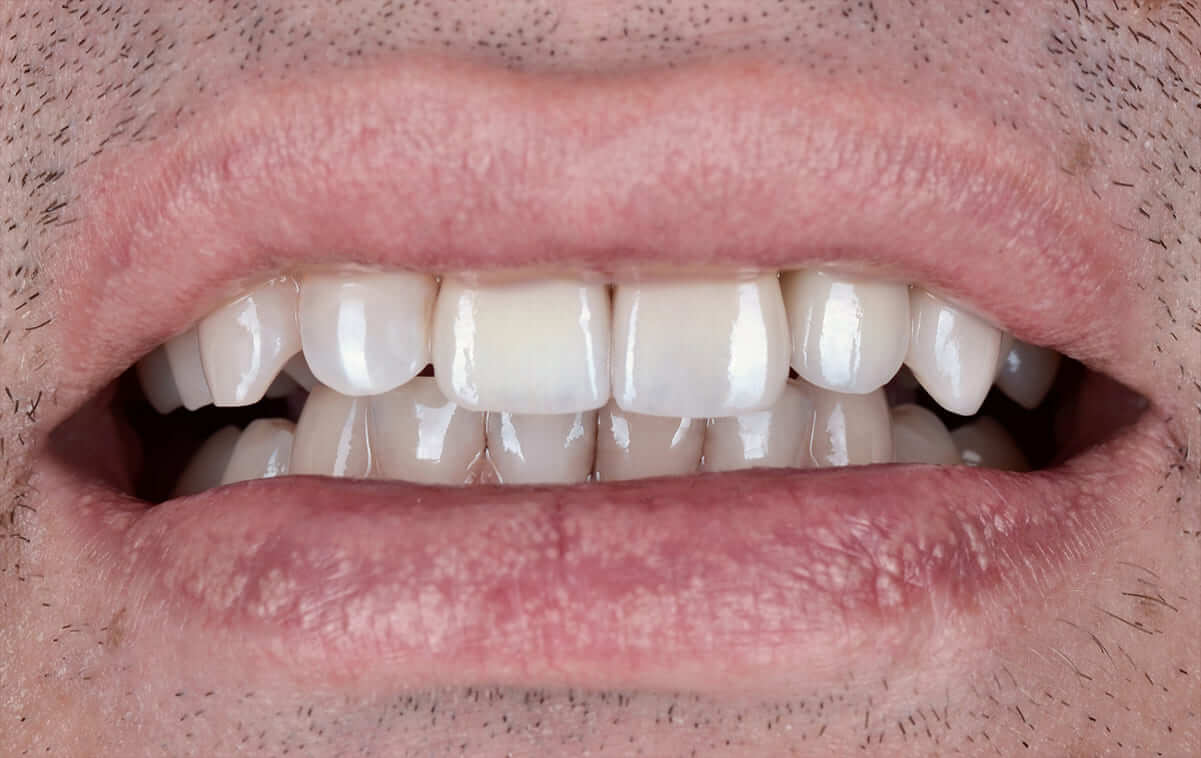 Протезирование фронтальных зубов циркониевыми коронками после спортивной травмы