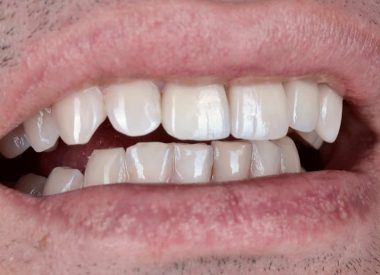 Нашим техніком були виготовлені цирконієві коронки з редуціюванням керамікою на 11, 22 зуби, цільнокерамічна коронка на 21 зуб і керамічний вінір на 23 зуб.