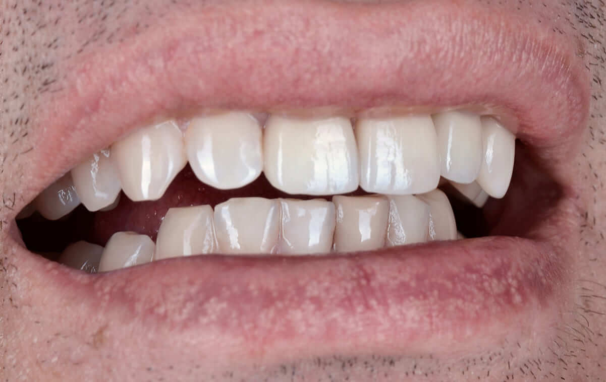 Our technician made zirconia crowns with ceramic reduction for 11, 22 teeth, an all-ceramic crown for 21 teeth, and a ceramic veneer for 23 teeth.