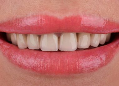 Пацієнтка звернулась з причини незадовільного естетичного вигляду зубів. Під час клінічного огляду помічено, що металокерамічні реставрації на верхній щелепі не вписувались в загальну картину, були безжиттєвими та з несиметричними ясеневими зенітами.