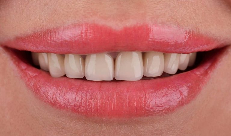 Пациентка обратилась из-за неудовлетворительного эстетического вида зубов. При клиническом осмотре замечено, что металлокерамические реставрации на верхней челюсти не вписывались в общую картину, были безжизнеными и с несимметричными десневыми зенитами.