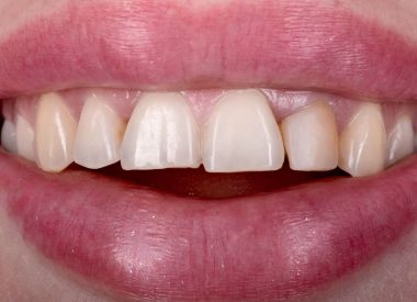 Пацієнтка, після закінченого ортодонтичного лікування в іншому медичному закладі, звернулася до нас з бажанням отримати красиву посмішку з максимально світлими зубами.