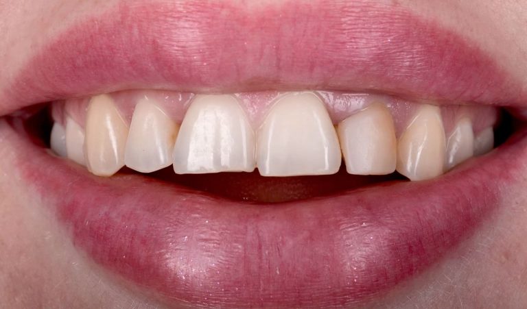 BL1 color ceramic veneers after orthodontic treatment