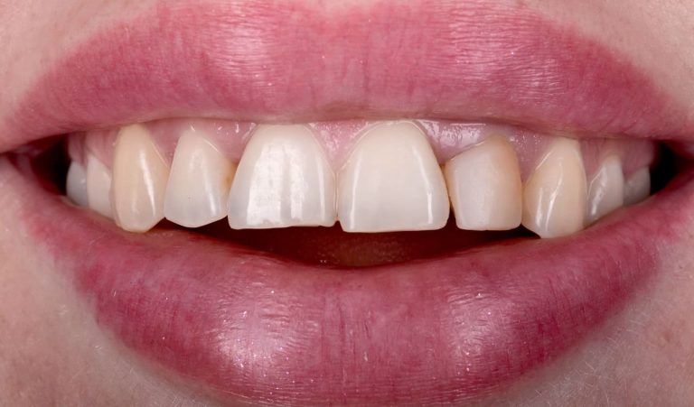After completing orthodontic treatment at another health center, the patient came to us with a desire for a beautiful smile with the lightest possible teeth.