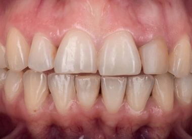 После обсуждения предложенного нами плана лечения, была проведена препаровка 10 зубов на верхней и 10 зубов на нижней челюстях.