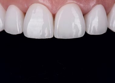 Within two weeks, the dental laboratory fabricated ceramic BL1 shade (maximum white) veneers fixed in one visit.