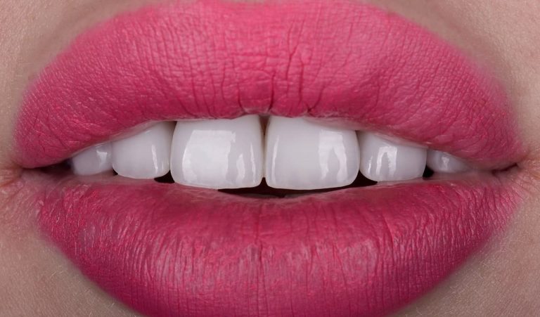 BL1 color ceramic veneers after orthodontic treatment