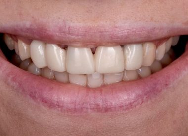 Пациентка обратилась к нам с желанием улучшить эстетический вид коронок на имплантатах. 6 месяцев назад после автомобильной аварии произошёл травматический перелом фронтальных зубов, в результате чего были удалены 13, 12, 11, 21, 22 зубы с одномоментной имплантацией 13, 12, 22 зубов.