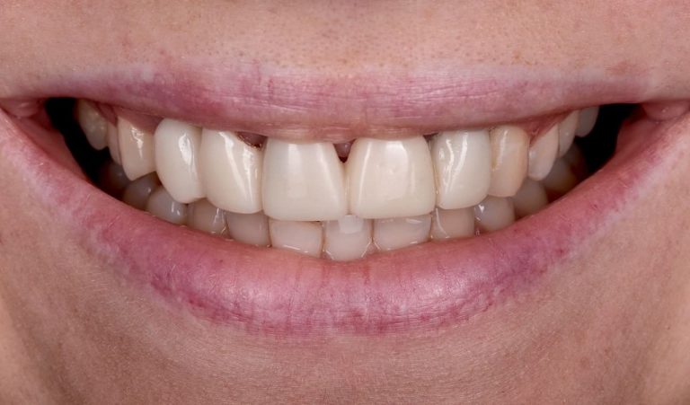 Пацієнтка звернулася до нас із бажанням покращити естетичний вигляд коронок на імплантатах. 6 місяців тому після автомобільної аварії стався травматичний перелом фронтальних зубів, внаслідок чого було видалено 13,12,11,21,22 зуби з одномоментною імплантацією 13,11,22 зубів.