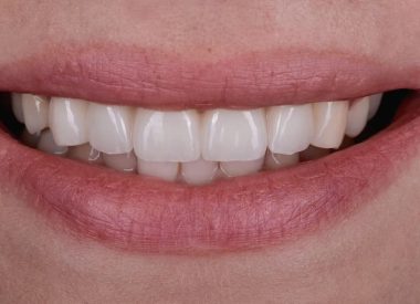 Ми запропонували виготовити індивідуальні цирконієві абатменти на імплантати 13,11,22 та цирконієвий мостоподібний протез з 13 по 22 зуби.