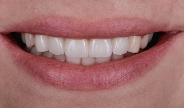 Prosthetics on implants of front teeth installed after a car accident