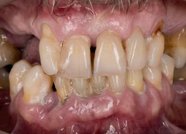 We suggested a two-stage treatment: – first stage. The patient had all teeth extracted under general anesthesia; 4 implants were fixed in the upper jaw, and 6 implants in the lower jaw. Two days later, we fixed the temporary crowns on both jaws. Thus, 4 days later, the patient returned home with a new beautiful...