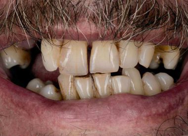 A patient from Portugal contacted the clinic with a request to get a beautiful smile. The check-up revealed that most of the teeth were loose; there was a foul smell and bleeding gums when brushing.